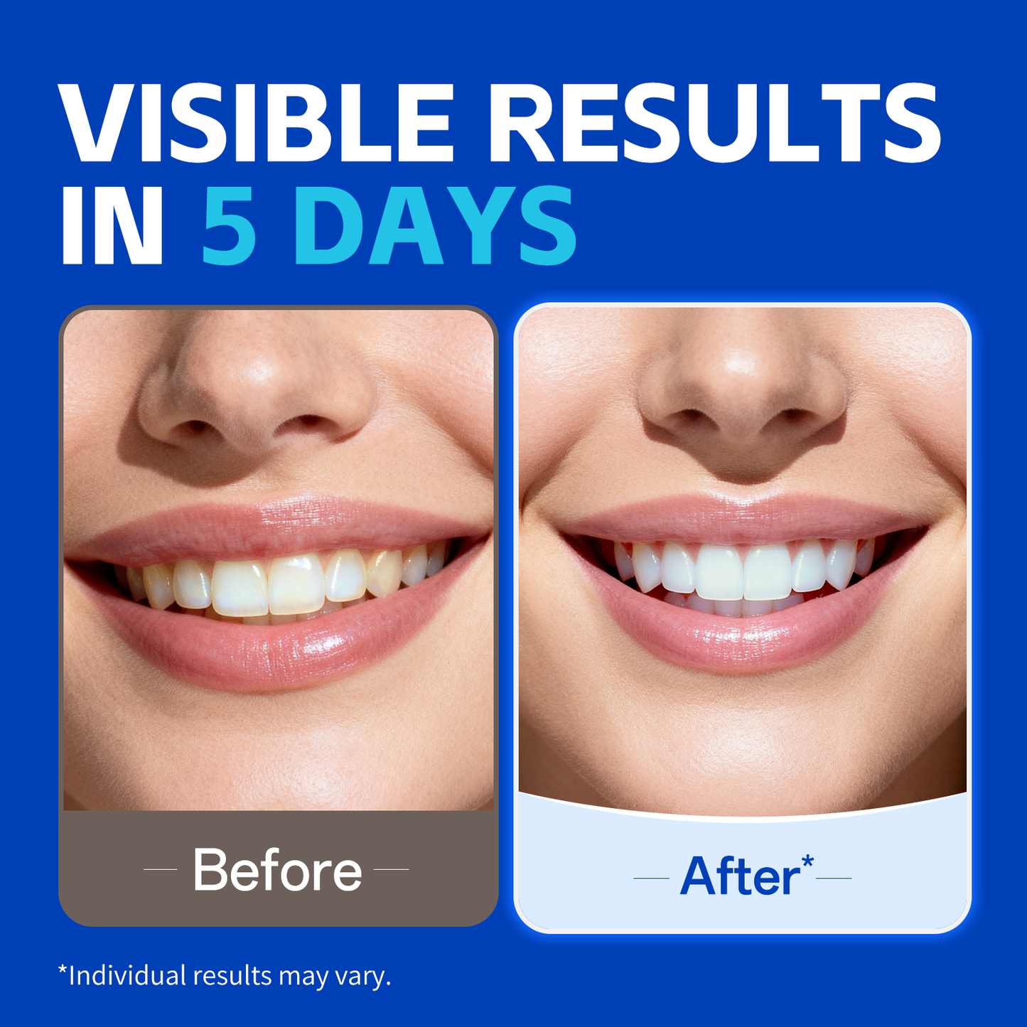 PERSMAX Teeth Whitening Strips – Professional Dentist Approved, Gum-Safe Formula, 28 Non-Slip Strips Kit, 14 Treatment, Pain-Free Express Whitening in 30 Min, Easy to Use for Bright Smile